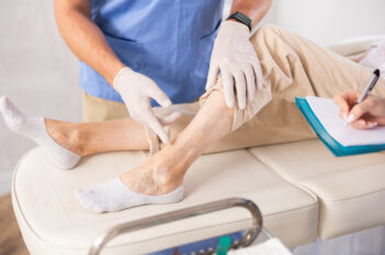 Varicose Veins